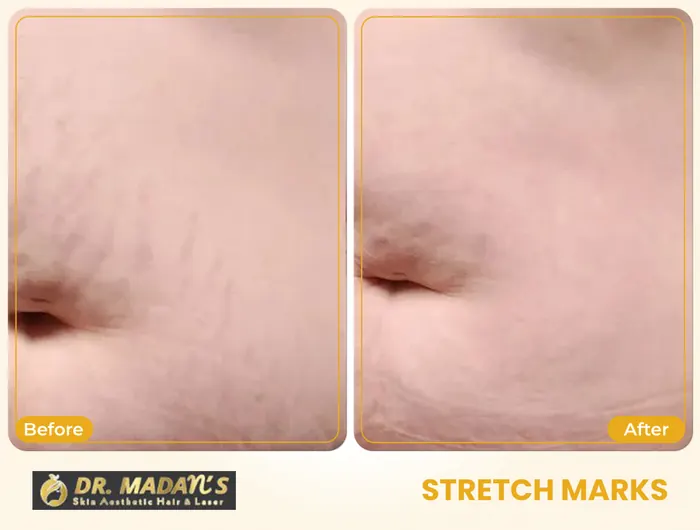 Stretch marks before and after result 3 at Dr Madan Aesthetics